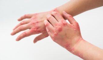 CURSO DE ATENCIÓN DE EMERGENCIAS POR ÁCIDO FLUORHÍDRICO