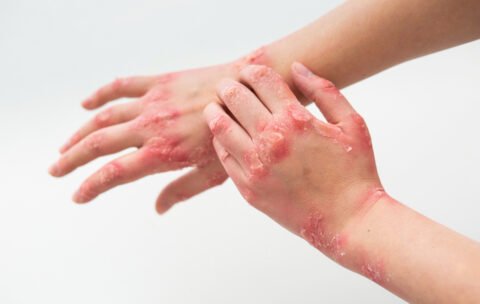 CURSO DE ATENCIÓN DE EMERGENCIAS POR ÁCIDO FLUORHÍDRICO